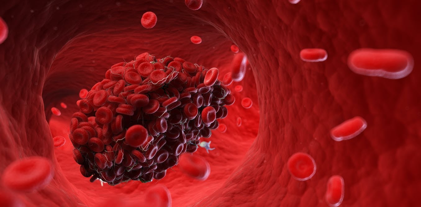 blood clots