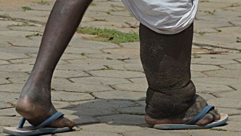 Elephantiasis